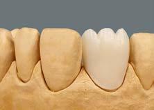 Para intensificação adicional da cor, as massas VITA INTERNO podem ser misturadas. As coroas revestidas sobre as bandejas de queima alveoladas prontas para a primeira queima de dentina.