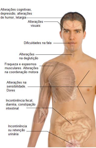 A esclerose múltipla normalmente se manifesta pela primeira vez entre os 20 e 40 anos de idade.