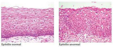 microinvasivo e carcinoma invasivo. Exemplos de alterações epiteliais no aspecto histopatológico são apresentadas na Figura 3 (Feitosa, 2013; Magi et al., 2006). Figura 3. Comparativo entre epitélio normal e anormal.