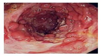 11 Figura 1 - Exame de colonoscopia em que se apresenta a formação de úlceras localizadas ao longo do tubo digestivo Fonte: Rodrigues (2016). 3.