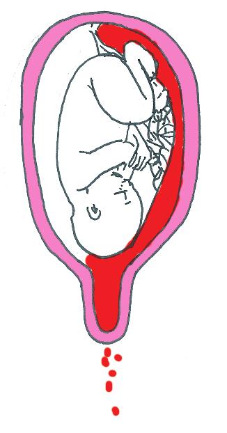 Endométrio Placenta Cordão umbelical Hemorragia Feto Colo do útero Hemorragia visível Figura 2.5: Ocorrência de hemorragia causada por DPP.