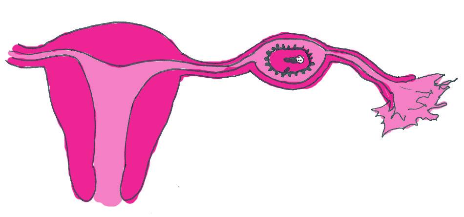 Gravidez ectópica Figura 2.7: Esta imagem mostra uma gravidez tubária. Agora, vamos entender melhor o caso de gravidez ectópica usando como exemplo a gravidez tubária.
