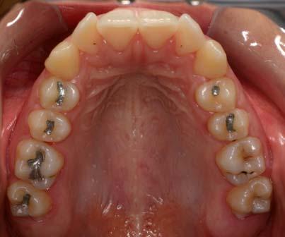 intrabucal lateral direita