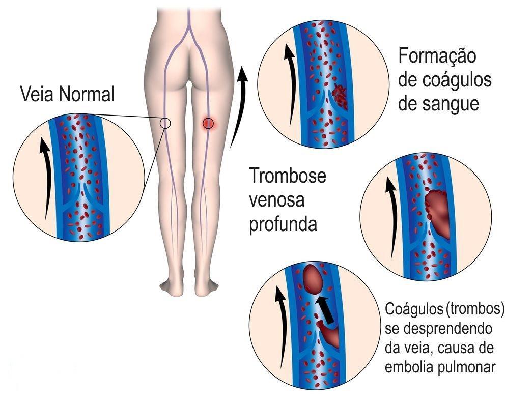 Quadro Clínico Tríade de Virchow: Estase venosa Hipercoagulabilidade Lesão do endotelial Imagem 1: https://cdn.