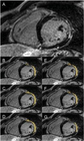4 Resultados 39 Figura 2 - Imagem de ressonância magnética cardíaca com técnica de realce tardio em eixo curto na porção basal mostrando fibrose miocárdica subendo/mesocárdica em segmentos anterior e