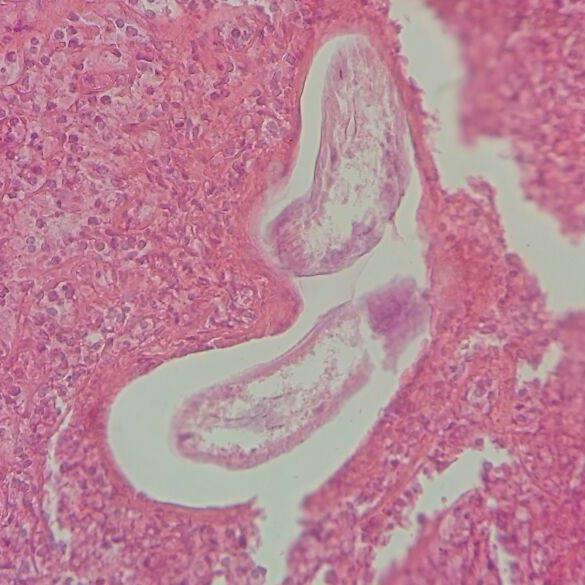 Figura 1- Àrea de calcificação e necrose envolto Figura 2- Infiltrado eosinófilico