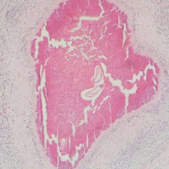 Infiltrado de eosinófilos, e presença de fragmentos do parasira Habronema sp (seta