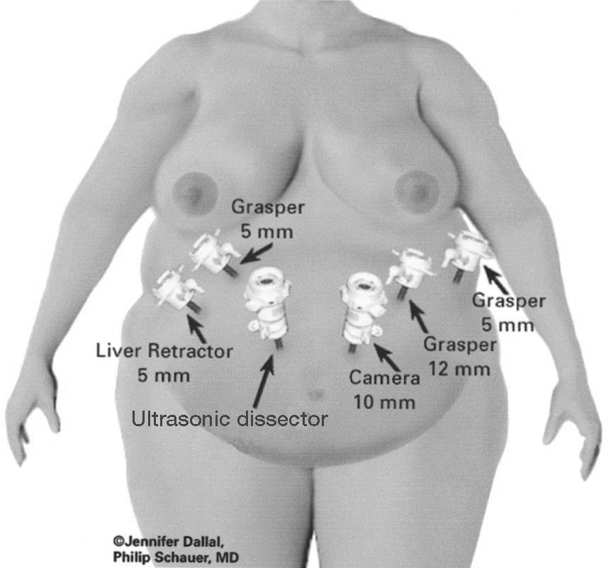A cirurgia bariátrica apresenta vários riscos peri-operatórios, mais acentuados nos indivíduos com obesidade.