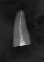 Figura 16 Radiografia de elemento dental obturado com cimento Portland 23 Produzido por Johnson e Jonhson Industrial