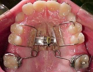INTRODUCTION Treatment of Class II malocclusion without skeletal involvement consists of distalization of the maxillary teeth to a Class I relationship, without having, however, any vertical