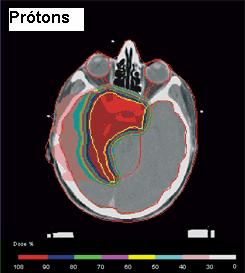 13 ilustra uma distribuição de doses (isodoses) sobre um tumor cerebral com fótons e depois com prótons.