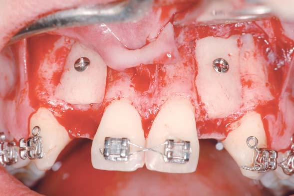 A opção escolhida foi o osso autógeno, colhido da linha oblíqua esquerda em dois blocos retangulares e fixados no sentido do longo eixo dos dentes por um parafuso da Neodent cada (Figuras 5 e 6).