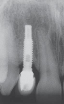 A agenesia, ausência congênita de pelo menos um dente, é a anomalia dental mais frequentemente encontrada em humanos 7.