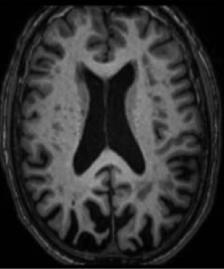 complexos Problemas de linguagem: nomeação, fluência Apraxia Apatia, ansiedade, depressão, delírios Agitação