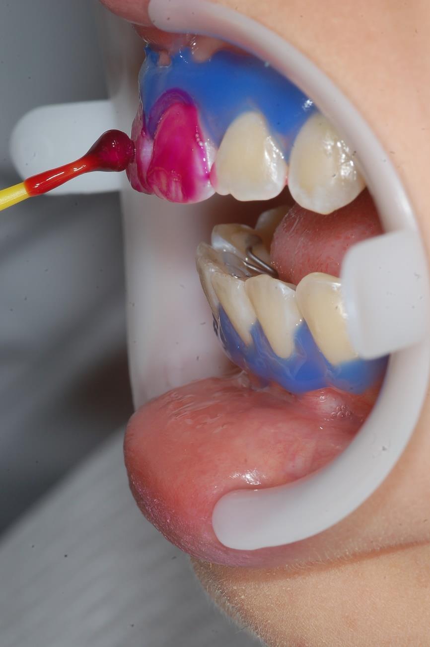 21 Após a remoção da dipirona/ placebo, o gel de peróxido de hidrogênio a 35% (Whiteness HP Maxx, FGM, Joinville, SC, Brasil) foi manipulado e aplicado sobre a vestibular dos dentes a serem clareados