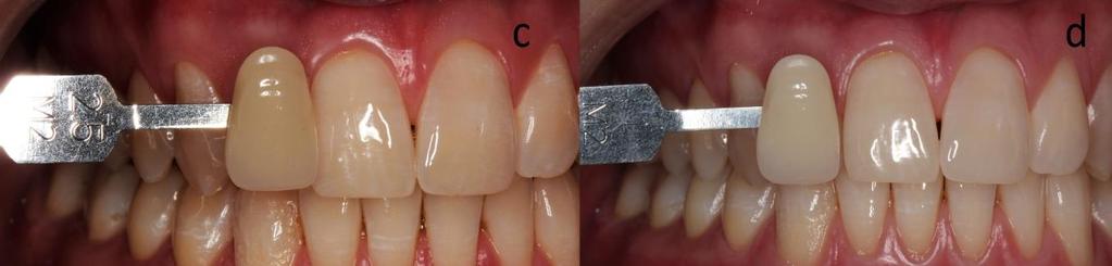 d) cor final Vita Bleachedguide 3D Master (1M2). 4.5.
