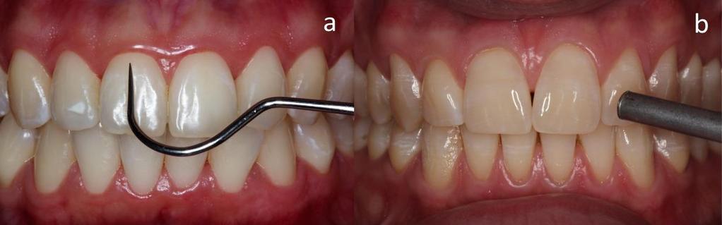 48 Figura 11 a) teste da sensibilidade basal: sondagem na região cervical do dente, b) teste da