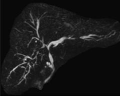 Primary Sclerosing Cholangitis Diagnosis, Prognosis