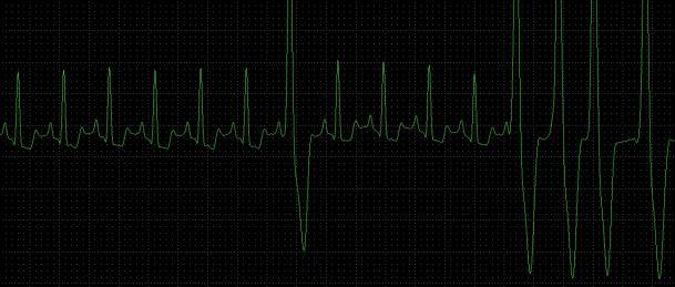 Flecainida Cão: 1-5 mg/kg VO BID-TID Encainida Complexo Ventricular Prematuro (isolado)