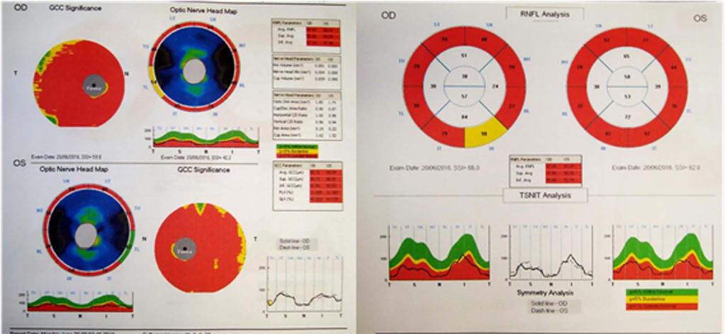 FIGURA 7. OCT de disco e CFNR evidenciando acentuada perda estrutural em ambos os olhos. REFERÊNCIAS 1. Lewis CJ, Hedberg-Buenz A, DeLuca AP, Stone EM, Alward WLM, Fingert JH.