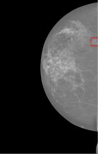 1b apresenta imagens resultantes do exame de mamografia. A Figura 2.1a é uma imagem com 16 bits disponibilizada pelo banco DDSM. A Figura 2.1b possui 12 bits e é disponibilizada pelo banco INbreast.