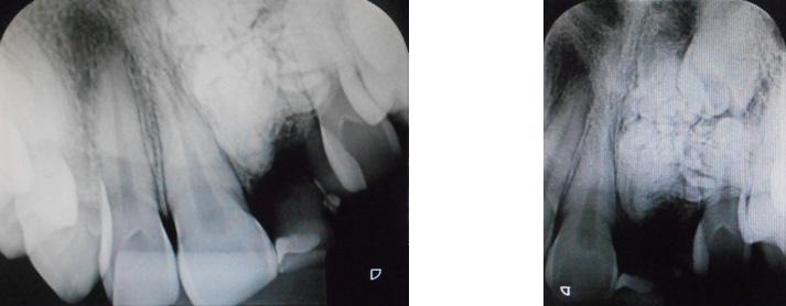 evidenciando massa radiopaca semelhante a dentículos, na região dos elementos 21 e