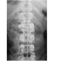 Avaliação radiográfica do colapso sagital na fratura toracolombar tipo B de Magerl 389 além do comprometimento das estruturas posteriores a presença de fragmentos retropulsados para o canal vertebral.