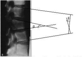 subtipo B21. O objetivo deste estudo foi analisar retrospectivamente o colapso sagital na fratura toracolombar tipo B21 dos pacientes submetidos ao tratamento conservador.