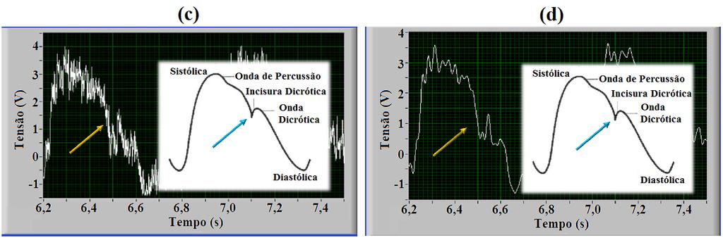 Já os sinais mostrados nas Figuras 8(b) e 8(d) são respectivamente os sinais das Figuras 8(a) e 8(c) filtrados por um filtro digital passa-baixas de 4ª ordem, com frequência de corte em 40 Hz.