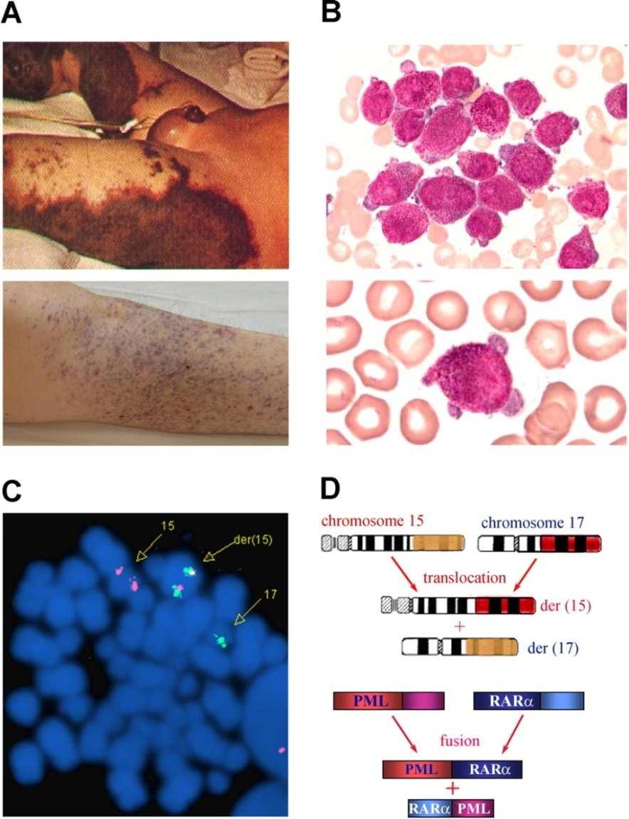 LPA: A) Acúmulo de promielócitos anômalos na MO B) Presença da fusão gênica PML-RARA ou suas variantes C) Tendência a grave coagulopatia devida a hipofibrinogemia e CIVD Mas não