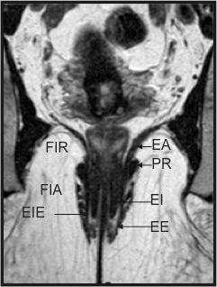 cirurgicamente sem que ocorra perda da continência fecal.