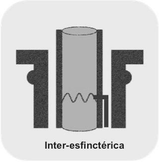 pode atingir a pele percorrendo diferentes trajectos que caracterizam os diferentes tipos de fístulas [1].