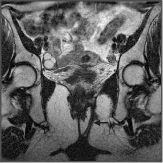 Fig. 5 Imagem coronal T2-w onde se identifica fístula inter-esfinctérica (seta).