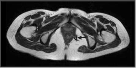 Fig. 9 Imagem axial T2-w onde se observa a mesma fístula transesfinctérica da imagem anterior (seta) a perfurar o complexo esfincteriano atingindo a fossa isquio-anal. Fig.