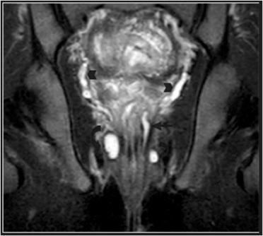 14 Imagens sagital (a), coronal (b) e axial (c) T2-w e imagem axial ponderada em STIR (d) onde é possível identificar uma fístula extra-esfinctérica (setas).