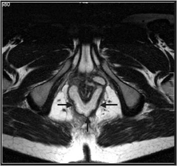 as fossas isquio-rectal e isquio-anal. A utilização simultânea de ambas as antenas seria a situação ideal [1, 8, 9, 10]. Os planos de imagem obtidos devem ter em consideração alguns aspectos.