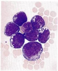 11 Figura 7 - Leucemia linfóide aguda, subtipo L3; células primitivas imaturas com citoplasma de coloração azul intensa; numerosos vácuolos perinucleares pequenos; aspecto associado geralmente com o