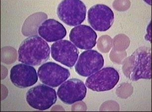 8 Figura 4 Células blásticas de paciente com LLA (aspirado de medula óssea). Proliferação desordenada das células linfóides imaturas (linfoblastos) Fonte: (OLIVEIRA; DINIZ; VIANA, 2004).