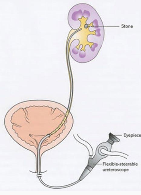 Ureterorrenoscopia LITÍASE URINÁRIA DA VIGILÂNCIA AO