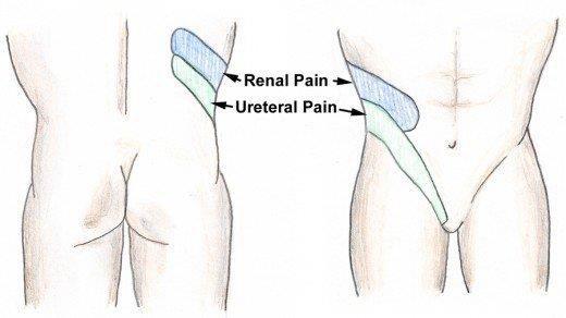 Cólica Renal Causa comum de recorrência ao Serviço de Urgência Clínica: Dor: Cólica Constante -cápsula renal Dor inguino-escrotal Náuseas e