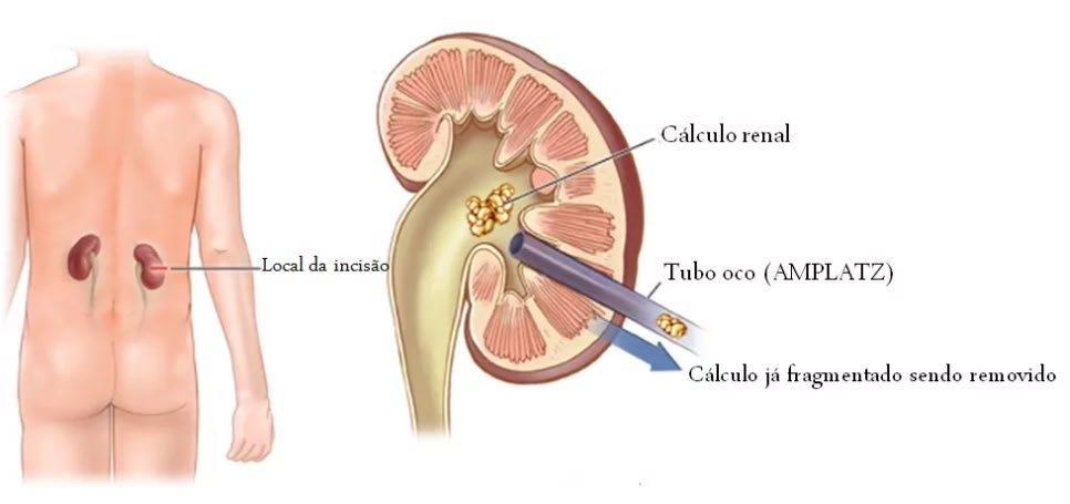 REMOÇÃO ATIVA LITÍASE URINÁRIA DA VIGILÂNCIA AO TRATAMENTO Nefrolitotomia Percutânea A TC abdominal