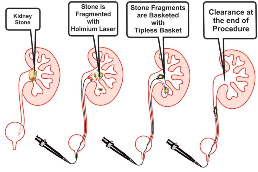 REMOÇÃO ATIVA LITÍASE URINÁRIA DA VIGILÂNCIA AO TRATAMENTO Cirurgia intrarrenal retrógrada (Retrograde IntraRenal Surgery - RIRS) -