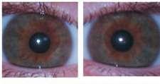 OCA2 principal região para olhos marrons