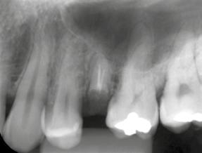 capítulo 02 DESGASTE DAS PROXIMAIS DOS DENTES ADJACENTES Em alguns casos o espaço protético apresenta-se