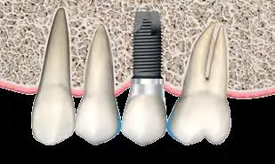 Para a complementação do planejamento, deve ser realizado um enceramento diagnóstico nos modelos de estudo para avaliar a proporção mésio-distal dos dentes envolvidos e respectivos dentes