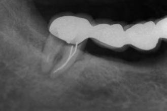 Reabilitação Oral AVALIAÇÃO DOS DENTES E TECIDOS MOLES ADJACENTES A análise da condição dos dentes e tecidos moles adjacentes ao espaço desdentado é de fundamental importância, visto que o sucesso da