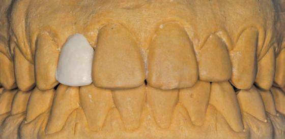 relação com os dentes antagonistas; relacionamento com o tecido mole e a necessidade de gengiva artificial ou