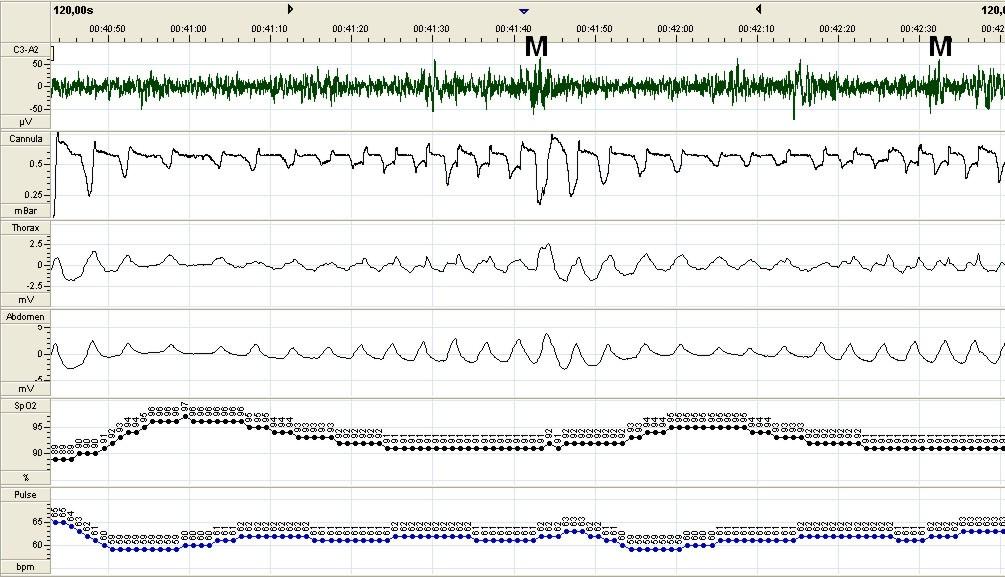 Introdução 4 FONTE: Laboratório do sono, InCor Figura 1b Registro de 120 segundos de polissonografia de paciente apresentando uma hipopnéia.