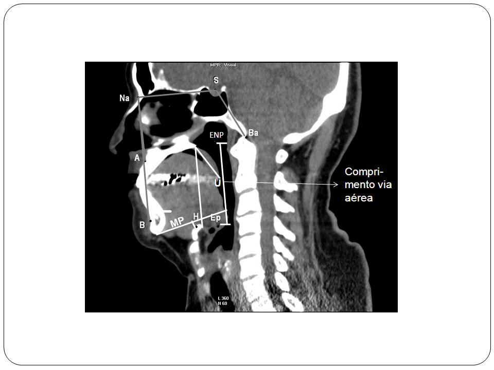 Métodos 39 Figura 14a Variáveis analisadas em corte sagital de tomografia computadorizada Definição das abreviaturas: A, ponto mais profundo na curva da maxila entre a espinha nasal anterior e o