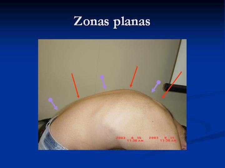 Aumento dos espaços interespinhosos. Tensão músculo-ligamentar posterior. Costelas posteriores.